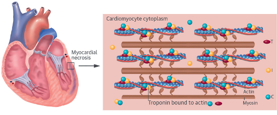 Myocardial necrosis